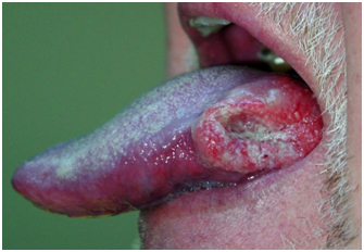 Diagnosis & Treatment of Oral Lesions